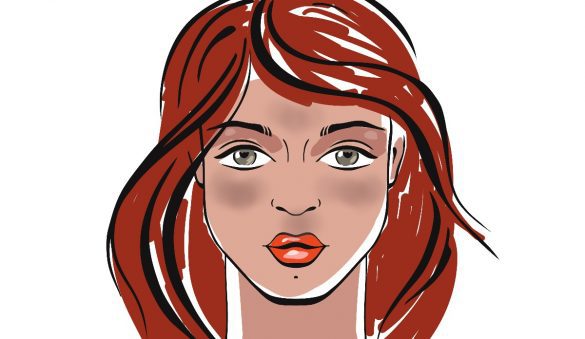 melasma en piel morena