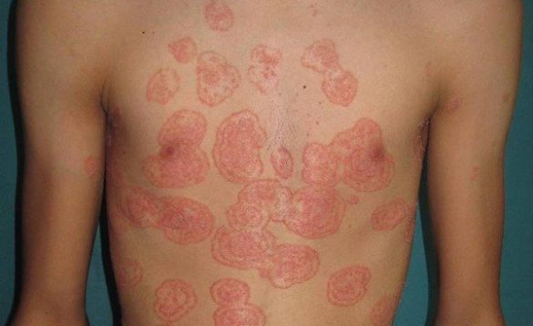 tinea corporis