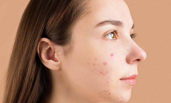 acne hormonal