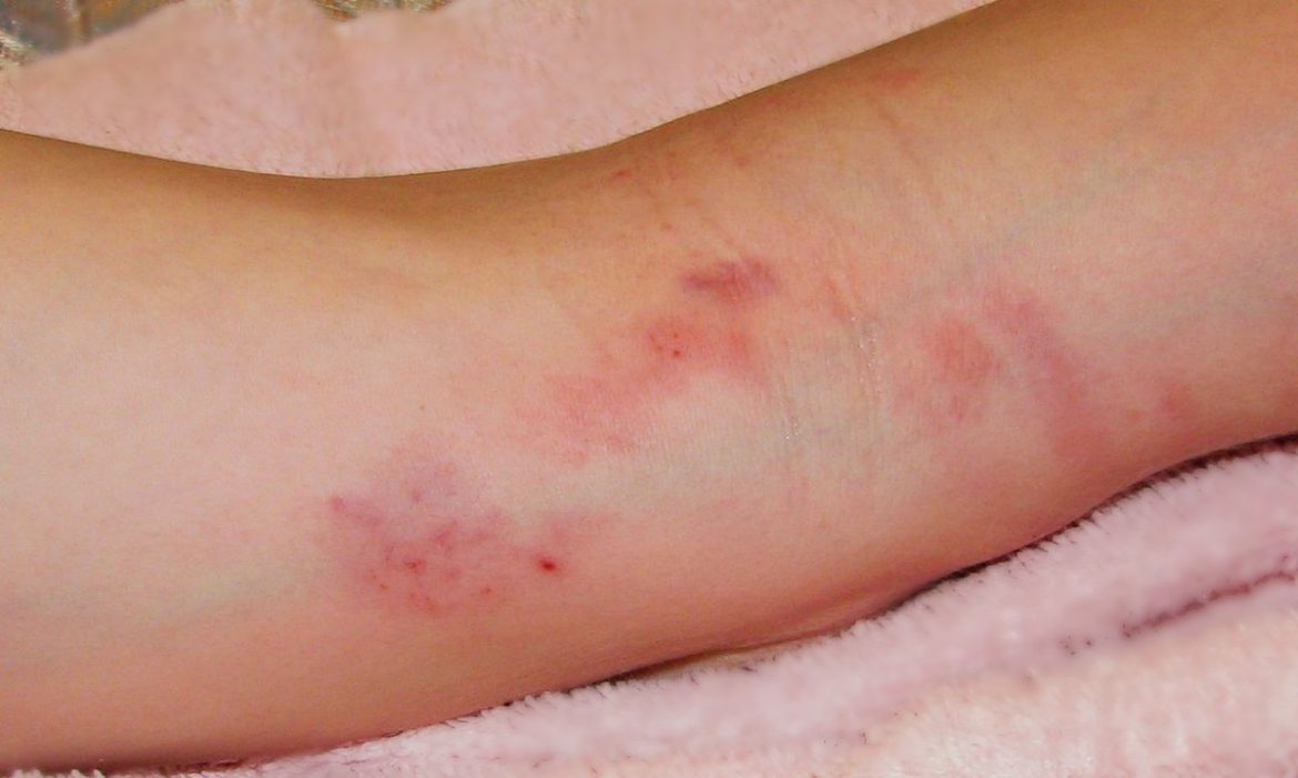 dermatitis y cáncer