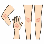 frictional lichenoid dermatitis